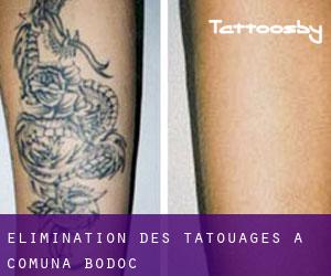 Élimination des tatouages à Comuna Bodoc