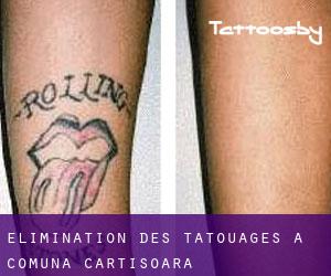 Élimination des tatouages à Comuna Cârţişoara