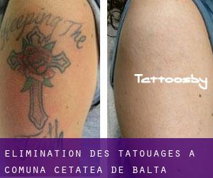 Élimination des tatouages à Comuna Cetatea de Baltă