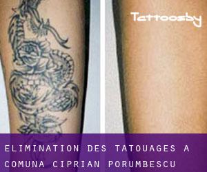 Élimination des tatouages à Comuna Ciprian Porumbescu