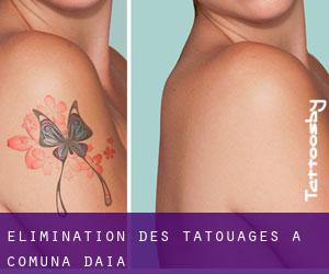 Élimination des tatouages à Comuna Daia