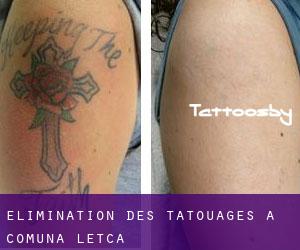 Élimination des tatouages à Comuna Letca