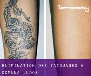 Élimination des tatouages à Comuna Ludoş