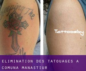 Élimination des tatouages à Comuna Mănăştiur