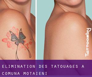 Élimination des tatouages à Comuna Moţãieni