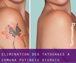 Élimination des tatouages à Comuna Putineiu (Giurgiu)