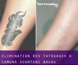 Élimination des tatouages à Comuna Scorţeni (Bacău)