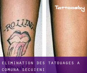 Élimination des tatouages à Comuna Secuieni