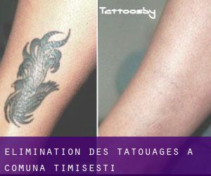 Élimination des tatouages à Comuna Timişeşti