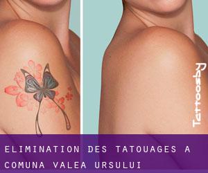 Élimination des tatouages à Comuna Valea Ursului