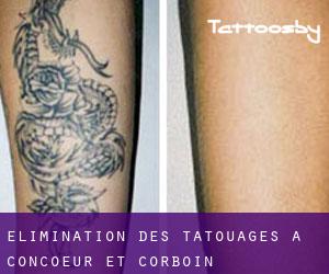 Élimination des tatouages à Concoeur-et-Corboin