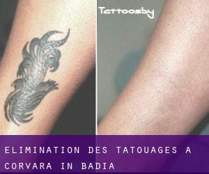 Élimination des tatouages à Corvara in Badia