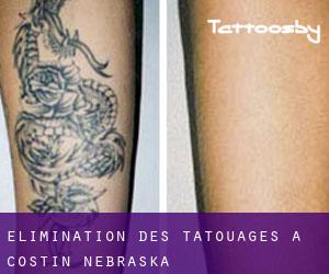 Élimination des tatouages à Costin (Nebraska)