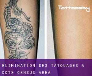 Élimination des tatouages à Côté (census area)