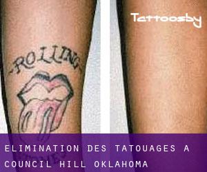 Élimination des tatouages à Council Hill (Oklahoma)