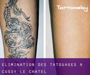 Élimination des tatouages à Cussy-le-Châtel