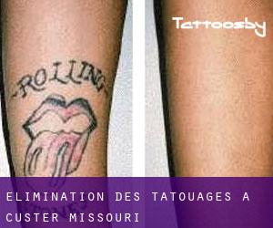 Élimination des tatouages à Custer (Missouri)