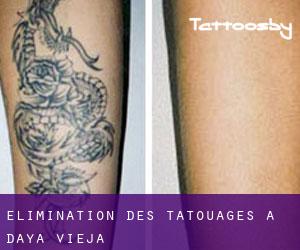 Élimination des tatouages à Daya Vieja