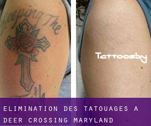 Élimination des tatouages à Deer Crossing (Maryland)