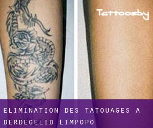 Élimination des tatouages à Derdegelid (Limpopo)