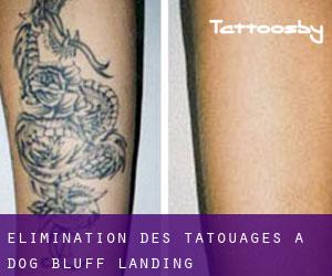 Élimination des tatouages à Dog Bluff Landing