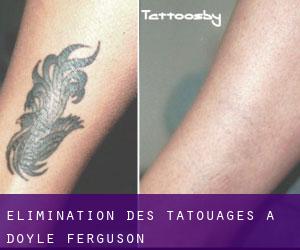 Élimination des tatouages à Doyle Ferguson