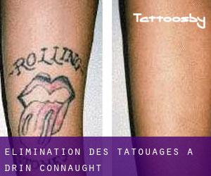 Élimination des tatouages à Drin (Connaught)