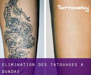 Élimination des tatouages à Dundas