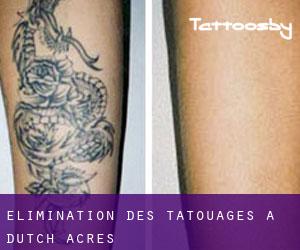 Élimination des tatouages à Dutch Acres