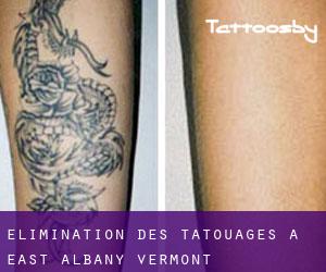 Élimination des tatouages à East Albany (Vermont)