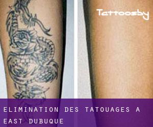 Élimination des tatouages à East Dubuque