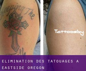 Élimination des tatouages à Eastside (Oregon)