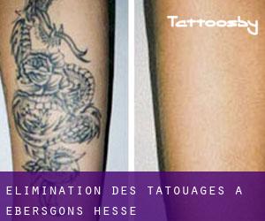 Élimination des tatouages à Ebersgöns (Hesse)