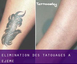 Élimination des tatouages à Ejeme