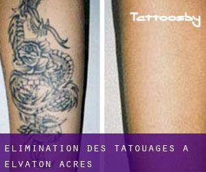 Élimination des tatouages à Elvaton Acres