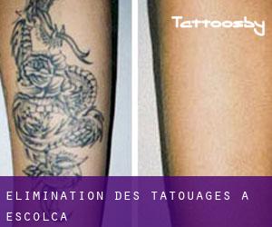 Élimination des tatouages à Escolca