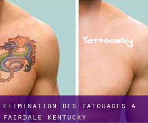 Élimination des tatouages à Fairdale (Kentucky)