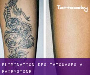 Élimination des tatouages à Fairystone