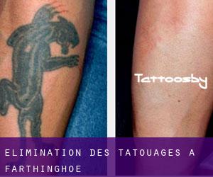 Élimination des tatouages à Farthinghoe