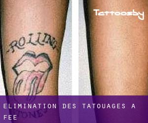 Élimination des tatouages à Fee