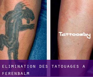 Élimination des tatouages à Ferenbalm