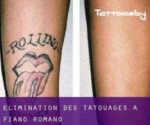 Élimination des tatouages à Fiano Romano