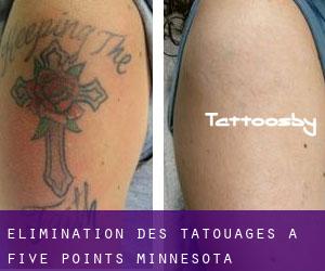 Élimination des tatouages à Five Points (Minnesota)