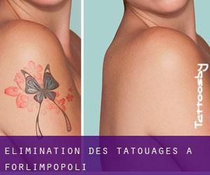 Élimination des tatouages à Forlimpopoli