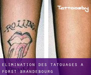 Élimination des tatouages à Forst (Brandebourg)