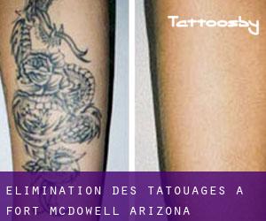 Élimination des tatouages à Fort McDowell (Arizona)