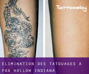 Élimination des tatouages à Fox Hollow (Indiana)