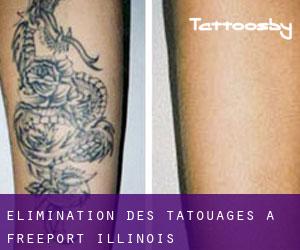 Élimination des tatouages à Freeport (Illinois)