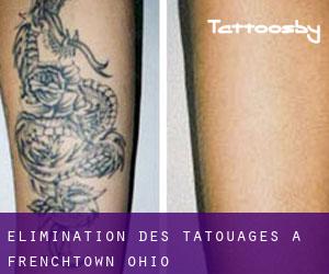 Élimination des tatouages à Frenchtown (Ohio)