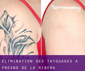 Élimination des tatouages à Fresno de la Ribera